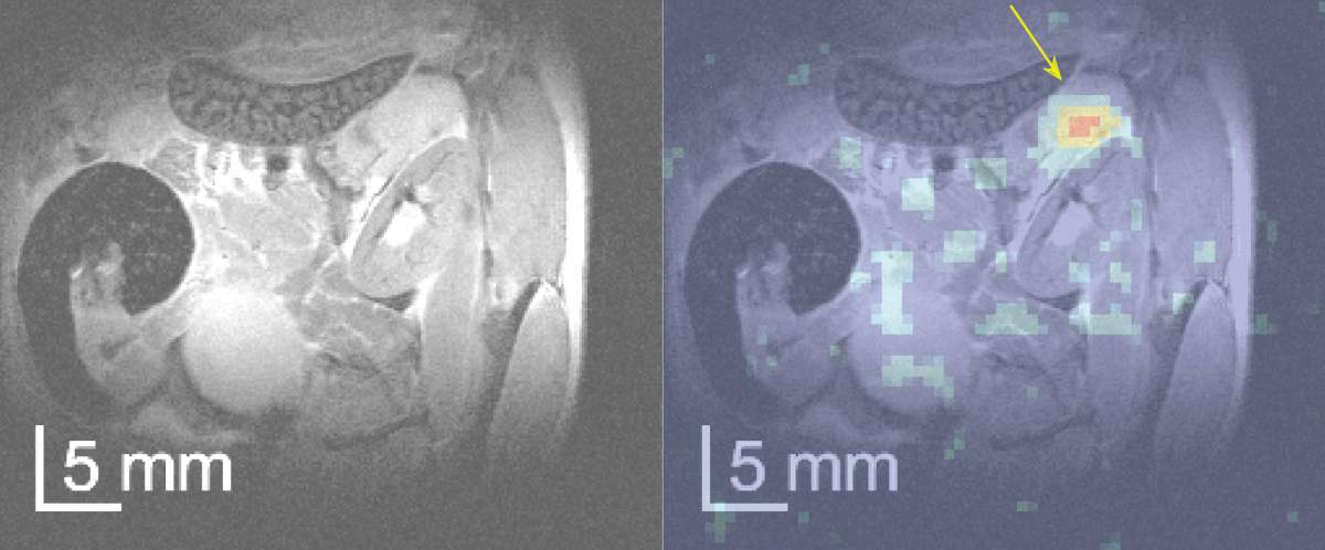 Une IRM classique (à gauche) n'a pas permis de détecter une tumeur pancréatique ; en revanche, cette tumeur a été clairement mise en évidence par l'IRM réalisée après une injection de glucose chimiquement modifié (à droite). 