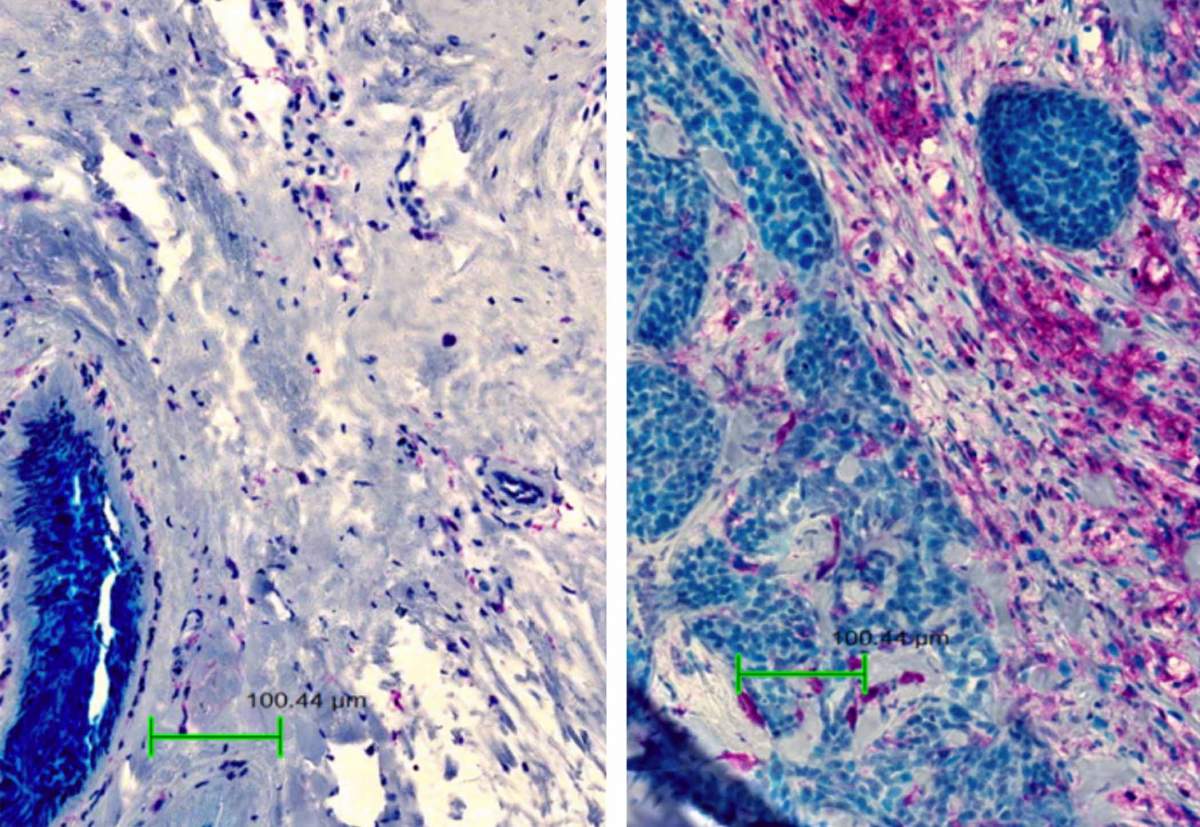 Coupe transversale d'un tissu mammaire sain (à gauche) et d'un tissu provenant d'une patiente atteinte d'un cancer du sein triple négatif (à droite). 